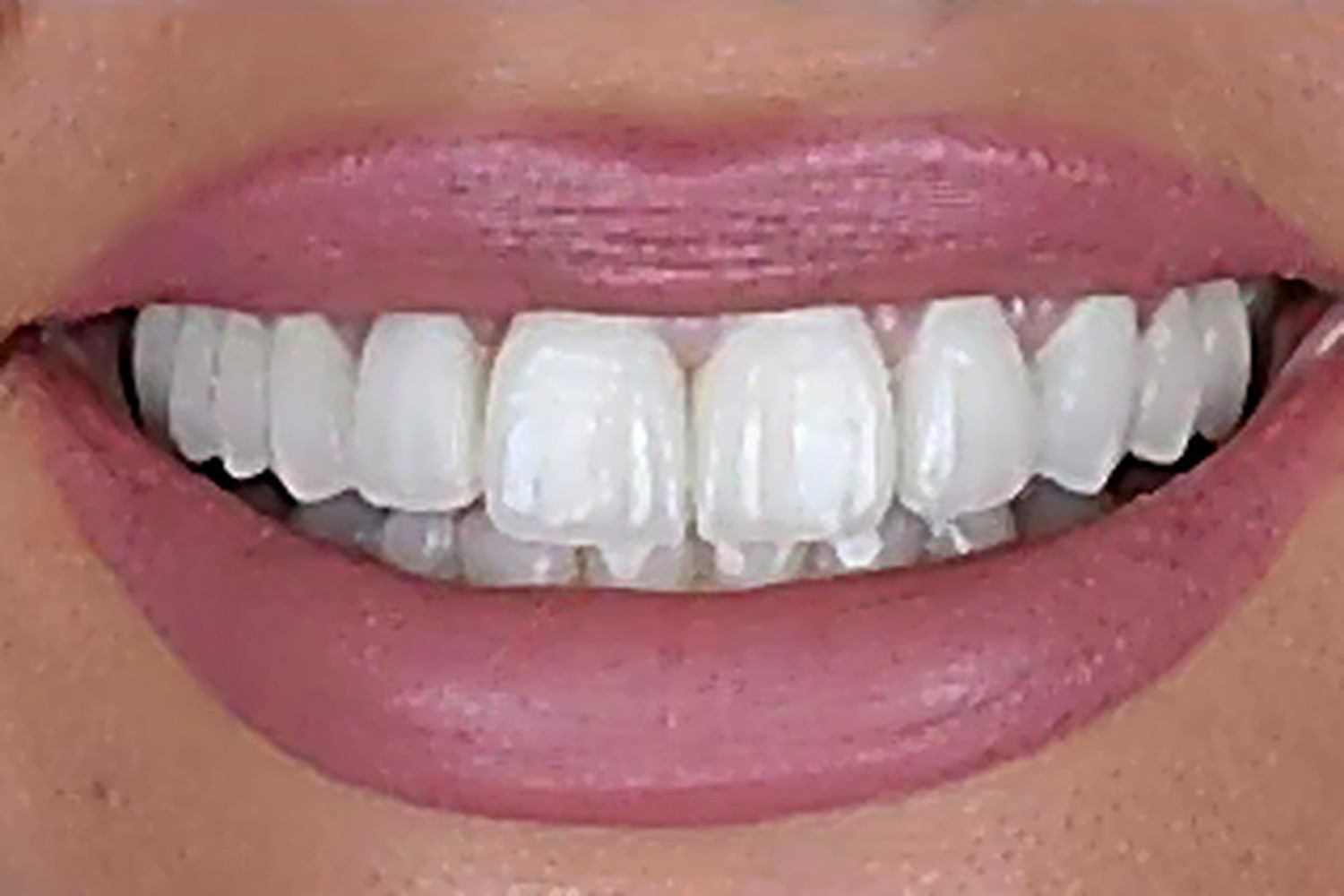 After — Cosmetic Dentistry