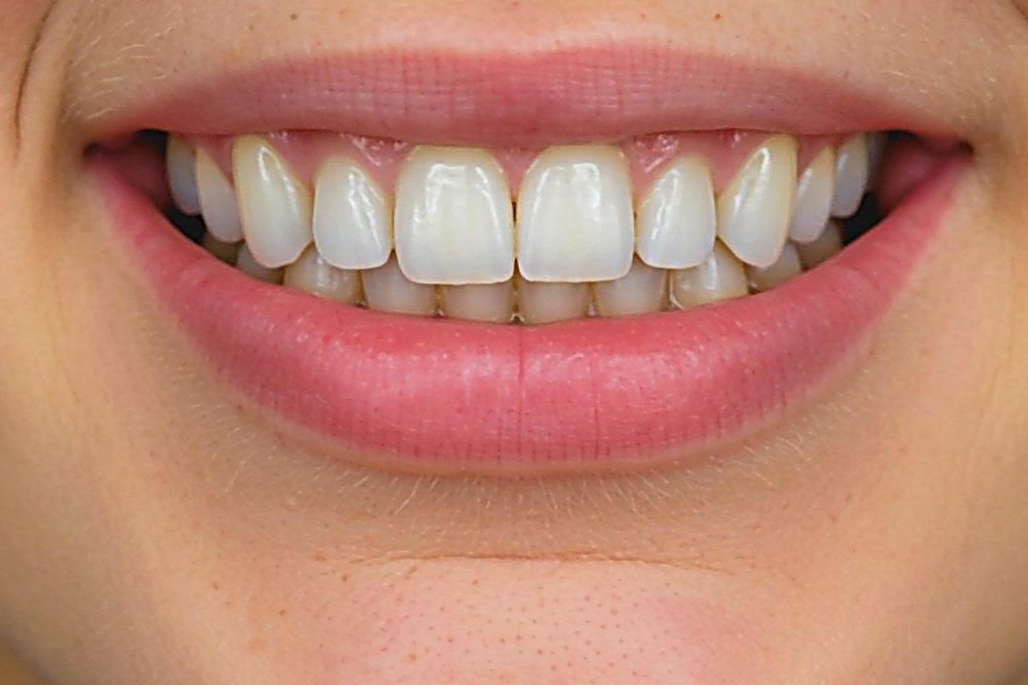 After — Same‑Day Crowns (CEREC)
