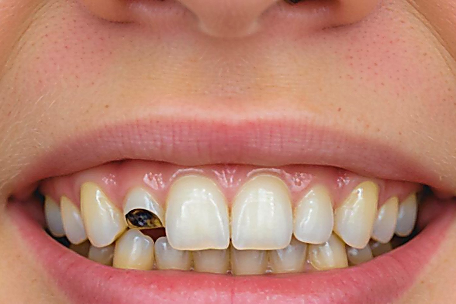 Before — Same‑Day Crowns (CEREC)