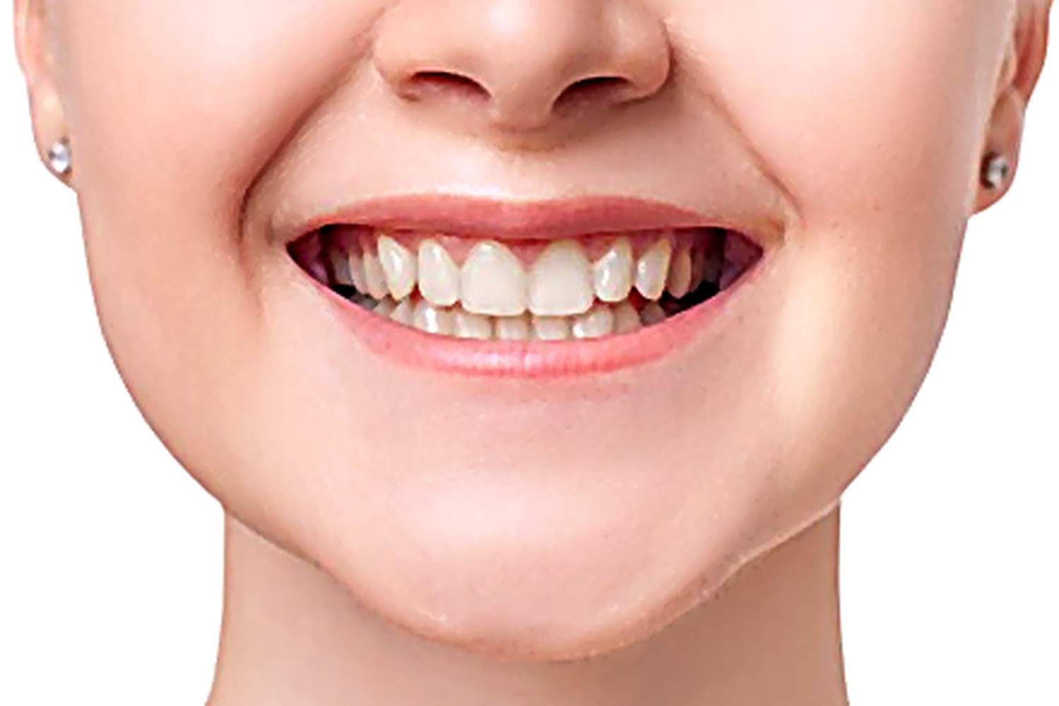 After — Dental Implants