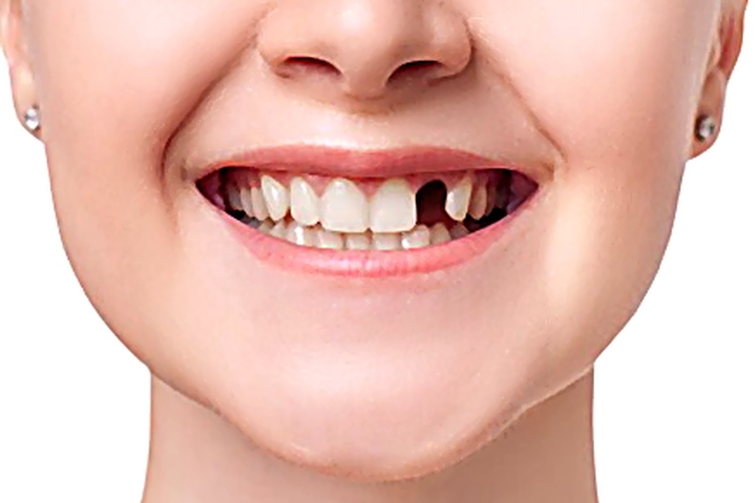 Before — Dental Implants