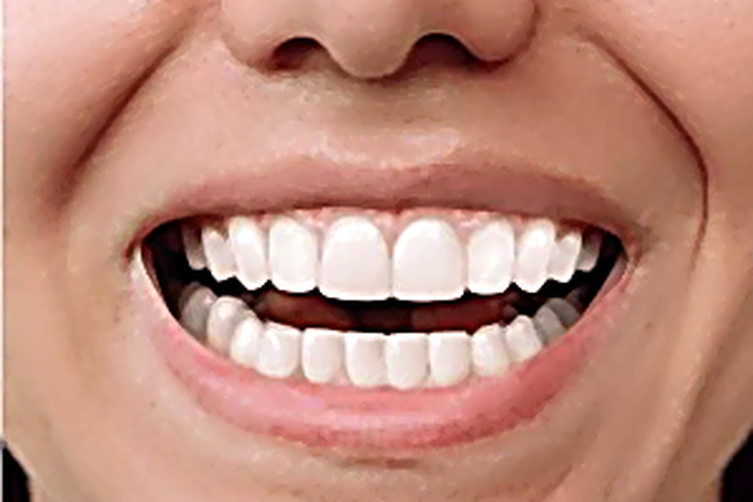 After — Invisalign® Clear Aligners