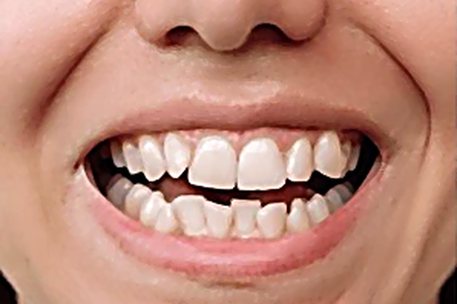 Before — Invisalign® Clear Aligners