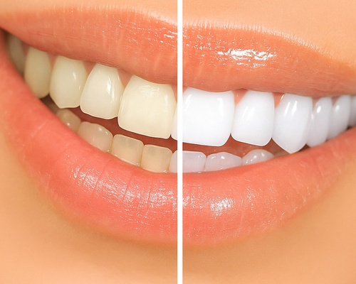 Professional Teeth Whitening: What to Expect